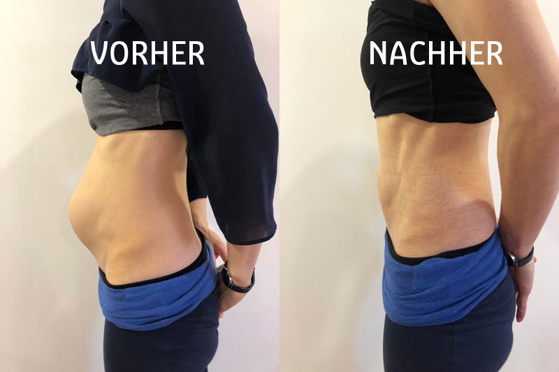 Vorher-nachher-Aufnahmen der Körpermitte mit blauem Bund