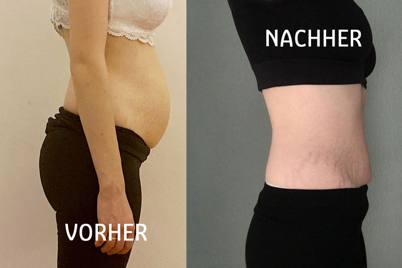 Vorher-nachher-Vergleich der Körpermitte in Seitenansicht