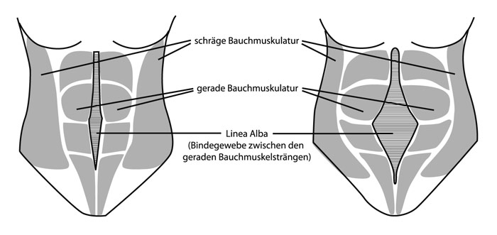 Rectusdiastase